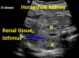 icd 10 code for horseshoe kidney